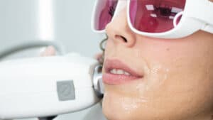 La Depilación Láser Facial