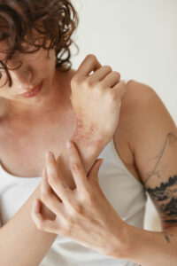 Depilación laser con dermatitis